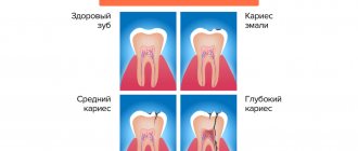 Stages of caries development in pictures