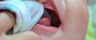 Stomatitis in babies