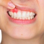 Fistula or lump on the gum - what to do?