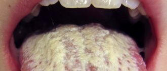 This is what a fungal infection on the tongue looks like