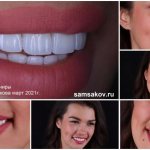 This is what women&#39;s Luxury veneers look like. The work of orthopedist Sergei Samsakov, March 2021 