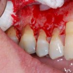 Severe periodontitis