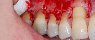 Severe periodontitis