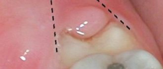 Удаление капюшона зуба - Стоматология Линия Улыбки