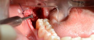 removal of a lying wisdom tooth