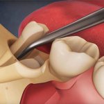 Wisdom tooth removal