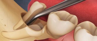 Wisdom tooth removal