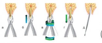 Removal of a tooth