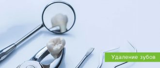 Tooth extraction