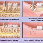 Wisdom teeth removal