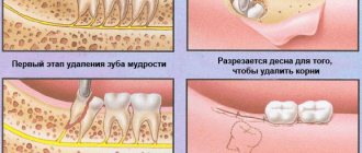 Удаление зубы мудрости