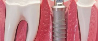 Installation of a dental implant