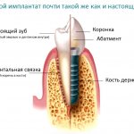 Установка имплантов пошагово