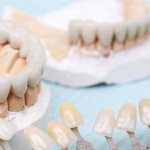 Установка несъемных зубных протезов