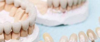 Установка несъемных зубных протезов
