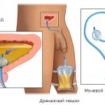 In most cases, during the operation, the surgeon leaves a drainage tube in the pelvic cavity (in the operation area).