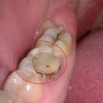 Gum has grown in the tooth hole