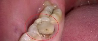 Gum has grown in the tooth hole