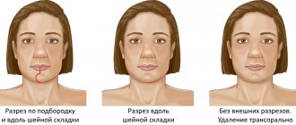 Incision options for mandibular resection