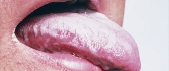 hiv mouth