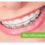 types of braces for correcting malocclusion