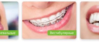 types of braces for correcting malocclusion