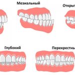 Types of occlusion defects and methods of their correction