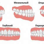 виды неправильного прикуса