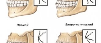 Types of correct bite