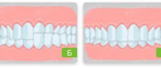 types of bite