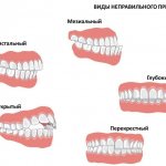 Types of bites