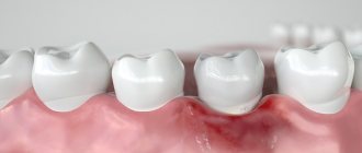 Gum inflammation after implant placement