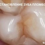 Restoring a tooth with a filling. Tooth restoration 