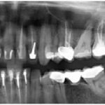 Possible consequences after filling with guta-percha