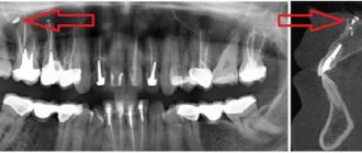 Possible consequences after filling with guta-percha