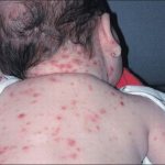 Congenital chickenpox