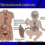 Congenital syphilis