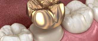 Dental crown