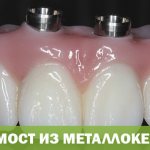 Зубной мост из металлокерамики