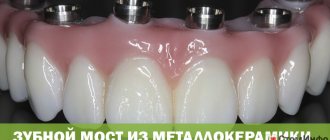 Зубной мост из металлокерамики