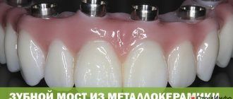 Metal-ceramic dental bridge