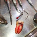 Dental pulpitis